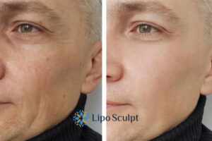 How to Fight Aging Symptoms 3 Fight Aging Symptoms Bibury With HIFU and Morpheus8 Today!