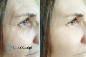How to Fight Aging Symptoms 2 Do you want to Fight Aging Symptoms Bibury? Contact Lipo Sculpt today!