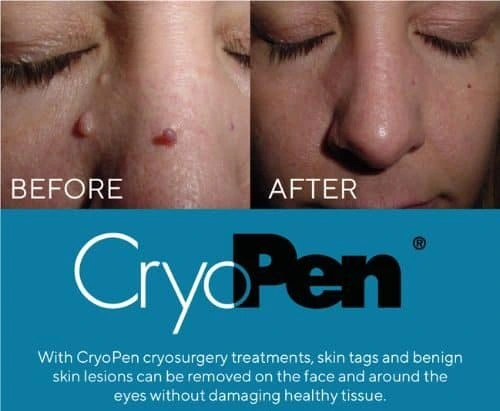 image of angiofibroma removal Bibury using Lipo Sculpt cryopen!